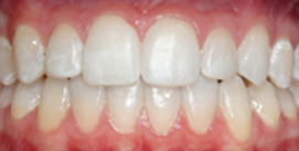 Nach Invisalign und Kieferkorrektur Patient Frontal Ansicht