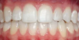 Nach Invisalign und Kieferkorrektur Patient Frontal Ansicht