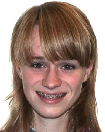 Kieferkorrektur