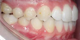 Nach Invisalign und Kieferkorrektur Patient rechte Seite