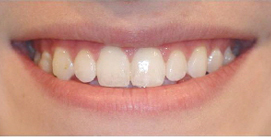 Kieferkorrektur mit Invisalign-Therapie