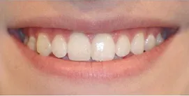 Kieferkorrektur mit Invisalign-Therapie