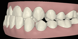 Digitale Ansicht vor Kieferkorrektur linke Seite