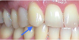 Spitzer Eckzahn vor Remodellation