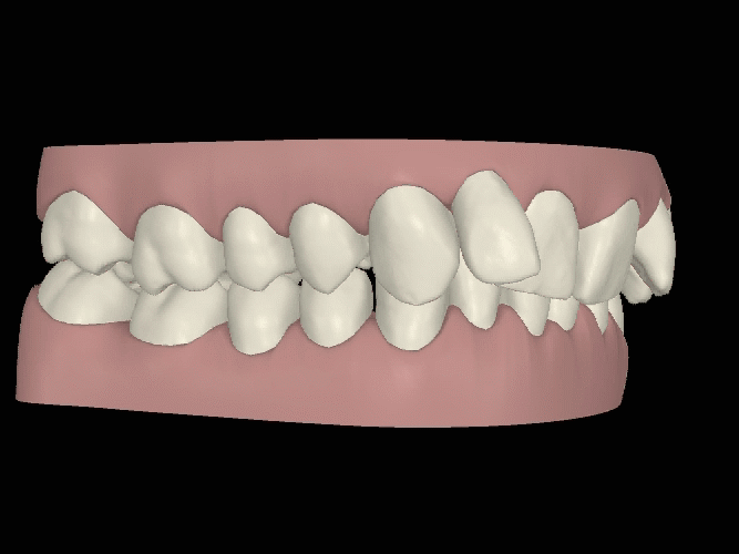 Unterkiefer-Chirurgie Animation