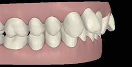 Vor Unterkieferchirurgie digitale Ansicht rechte Seite