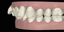 Vor Unterkieferchirurgie digitale Ansicht linke Seite