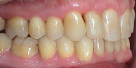 Nach Unterkiefer Chirurgie Patient rechte Seite