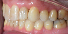 Nach Unterkiefer Chirurgie Patient linke Seite