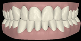 Nach Unterkiefer Chirurgie digitale frontal Ansicht