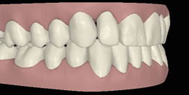 Nach Unterkiefer Chirurgie digitale rechte Ansicht