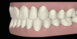 Nach Unterkiefer Chirurgie digitale linke Ansicht