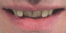 Vor Unterkiefer-Chirurgie mit Invisalign