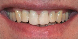 Nach Unterkiefer-Chirurgie mit Invisalign