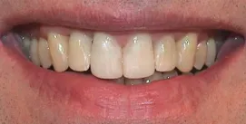 Nach Unterkiefer-Chirurgie mit Invisalign