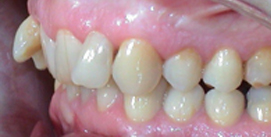 Vor Unterkieferchirurgie Patient linke Seite