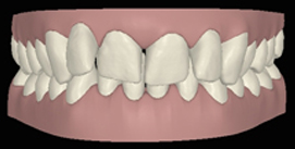 vor Behandlungsbeginn frontal digitale Ansicht