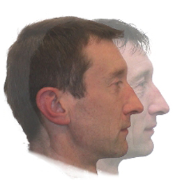 Unterkiefer-Chirurgie vorher/nachher