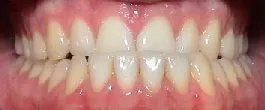 Patient mit Vorbiss frontal