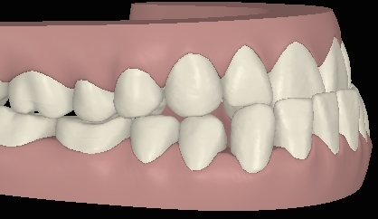 Clincheck mit Vorbiss rechte Seite