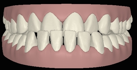 Clincheck mit Vorbiss frontal