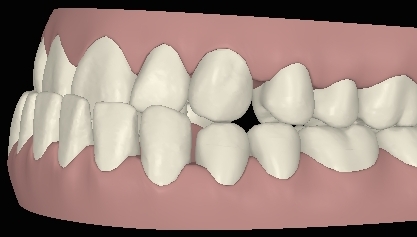 Clincheck mit Vorbiss linke Seite