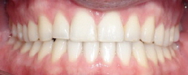 Patient Vorbiss mit Invisalign behandelt frontal