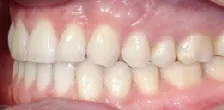 Patient Vorbiss mit Invisalign behandelt linke Seite