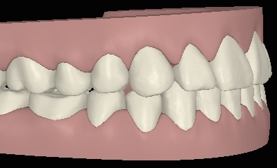 Digitale Ansicht Vorbiss mit Invisalign behandelt rechte Seite
