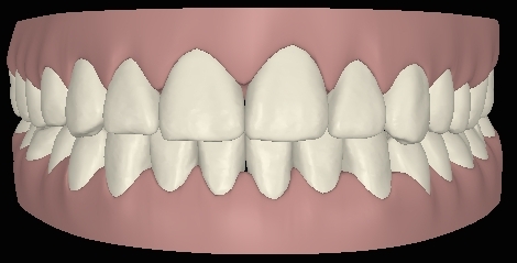 Digitale Ansicht Vorbiss mit Invisalign behandelt frontal