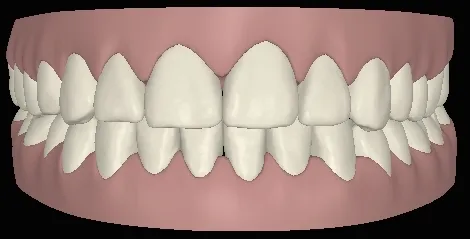 Digitale Ansicht Vorbiss mit Invisalign behandelt frontal