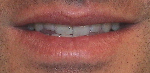 Vorbiss vor Behandlung