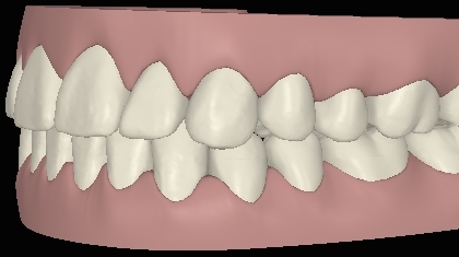 Digitale Ansicht Vorbiss mit Invisalign behandelt linke Seite