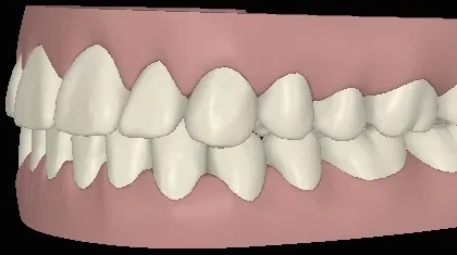 Digitale Ansicht Vorbiss mit Invisalign behandelt linke Seite