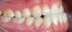 Patient Vorbiss mit Invisalign behandelt rechte Seite