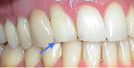 abgeflachter Eckzahn mit Zahnform