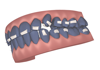 Attachments precision cuts