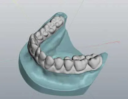 dvt digitale Abdrucknahme