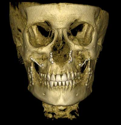 DVT Röntgen Aufnahme