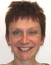 vor Invisalign-Gesichtschirurgie