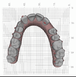 Invisalign-Therapieplanung bei Implantatversorgung - Clincheck