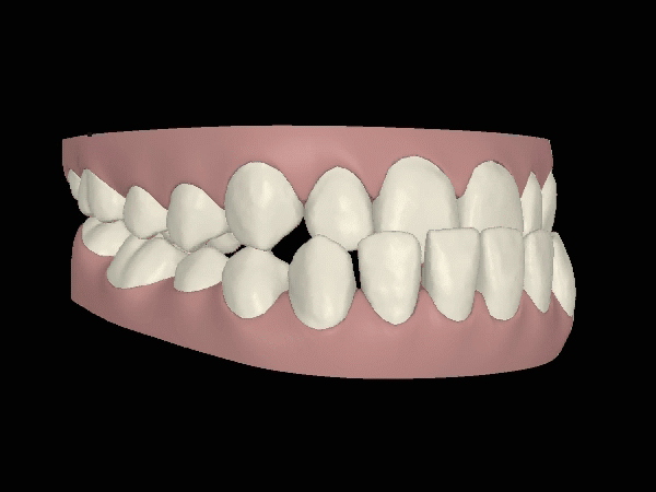 Kieferkorrektur Animation