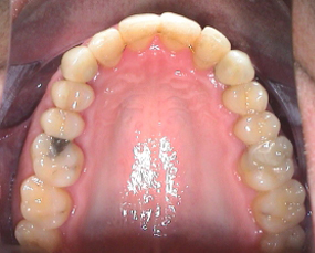 Eckzahn-Implantate eingesetzt