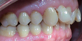 Vor Unterkieferchirurgie Patient rechte Seite