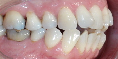vorher schneidezaehne-schief01 Patient rechts