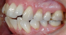 vorher schneidezaehne-schief03 Patient links