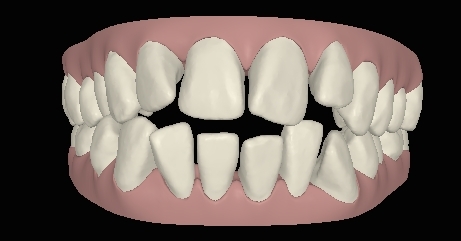 Engstand schneidezaehne-schief05 digital frontal