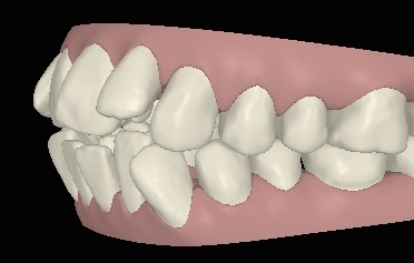 Engstand schneidezaehne-schief06 links digital