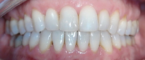 Engstand schneidezaehne-verschieben-sich02 Patient Frontal