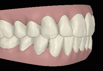 Engstand schneidezaehne-verschieben-sich04 rechts digital rechts